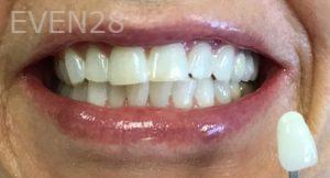 Mojgan-Niktash-Teeth-Whitening-after-2