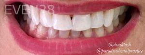 Mojgan-Niktash-Teeth-Whitening-after-3