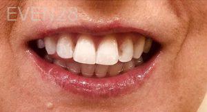 Mojgan-Niktash-Teeth-Whitening-after-4