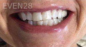 Mojgan-Niktash-Teeth-Whitening-after-5