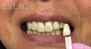 Mojgan-Niktash-Teeth-Whitening-before-1