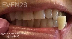 Mojgan-Niktash-Teeth-Whitening-before-2