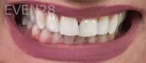 Mojgan-Niktash-Teeth-Whitening-before-3