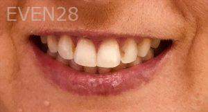 Mojgan-Niktash-Teeth-Whitening-before-4