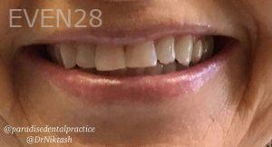 Mojgan-Niktash-Teeth-Whitening-before-5