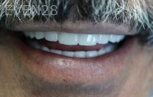 Nathan-Ding-All-on-four-Dental-Implants-after-1