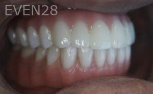 Nathan-Ding-All-on-four-Dental-Implants-after-1b