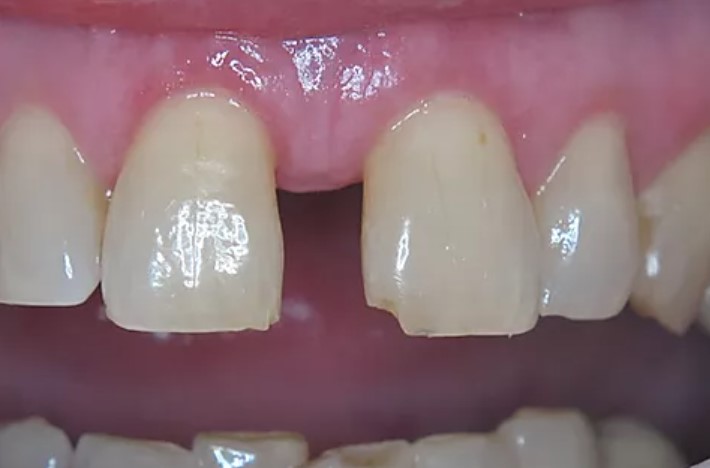 Nathan-Ding-Dental-Bonding-before-5