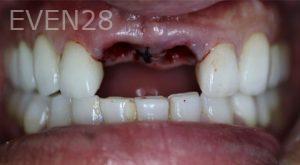 Nathan-Ding-Dental-Implants-before-1