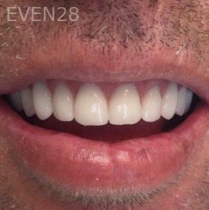 Nathan-Ding-Snap-on-Overdentures-Dental-Implants-after-1