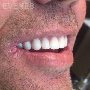 Nathan-Ding-Snap-on-Overdentures-Dental-Implants-after-1b
