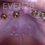 Nathan-Ding-Snap-on-Overdentures-Dental-Implants-before-1