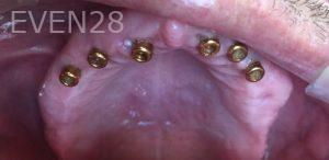 Nathan-Ding-Snap-on-Overdentures-Dental-Implants-before-1