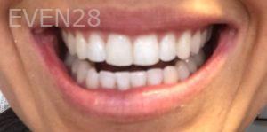 Nazanin-Zadeh-Invisalign-clear-aligners-after-1