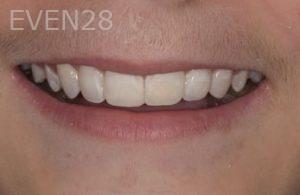 Nicholas-Davis-Dental-Bonding-after-12