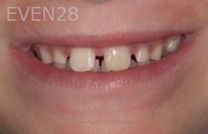 Nicholas-Davis-Dental-Bonding-after-2