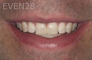 Nicholas-Davis-Dental-Bonding-after-7