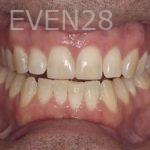 Nicholas-Davis-Dental-Bonding-after-8