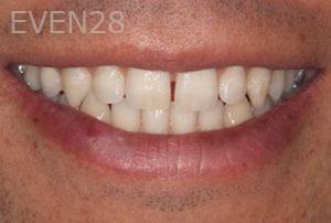 Nicholas-Davis-Dental-Bonding-before-1