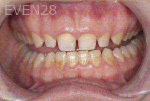 Nicholas-Davis-Dental-Bonding-before-10
