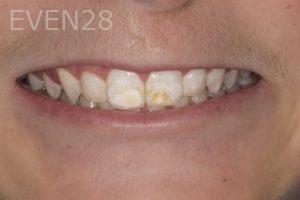 Nicholas-Davis-Dental-Bonding-before-12
