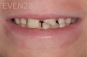 Nicholas-Davis-Dental-Bonding-before-2