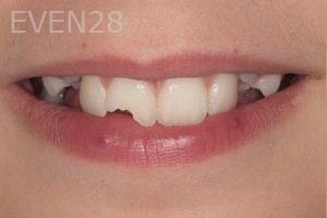 Nicholas-Davis-Dental-Bonding-before-3