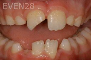 Nicholas-Davis-Dental-Bonding-before-4