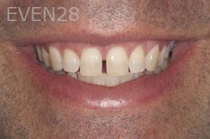 Nicholas-Davis-Dental-Bonding-before-7
