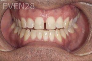 Nicholas-Davis-Dental-Bonding-before-8