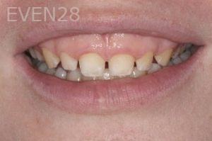 Nicholas-Davis-Dental-Bonding-before-9