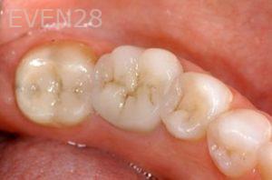Nicholas-Davis-Dental-Crowns-after-2