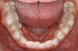 Nicholas-Davis-Dental-Crowns-after-3
