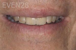 Nicholas-Davis-Dental-Crowns-after-5