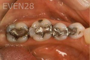 Nicholas-Davis-Dental-Crowns-before-1