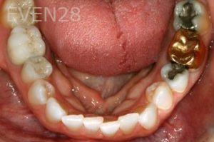 Nicholas-Davis-Dental-Crowns-before-3
