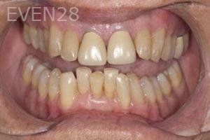 Nicholas-Davis-Dental-Crowns-before-4
