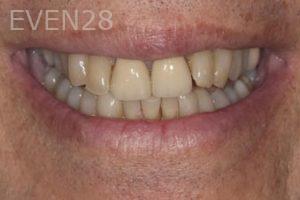 Nicholas-Davis-Dental-Crowns-before-5