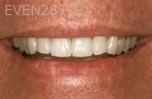 Nicholas-Davis-Dental-Implants-after-3