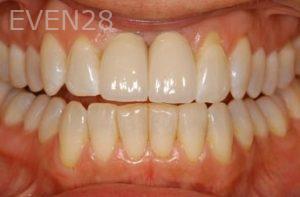 Nicholas-Davis-Dental-Implants-after-6