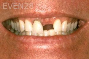 Nicholas-Davis-Dental-Implants-before-3
