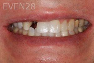 Nicholas-Davis-Dental-Implants-before-4