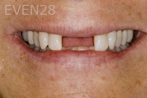 Nicholas-Davis-Dental-Implants-before-5