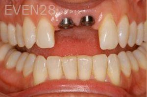 Nicholas-Davis-Dental-Implants-before-6