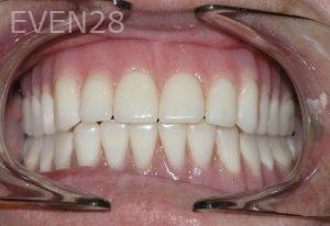 Nicholas-Shubin-All-on-four-dental-implant-after-1