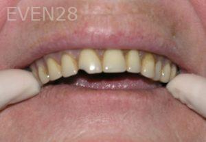 Nicholas-Shubin-All-on-four-dental-implant-before-1