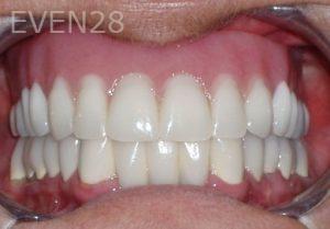 Nicholas-Shubin-Dental-Implants-after-1b