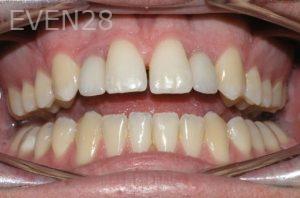 Nicholas-Shubin-Dental-Implants-after-3