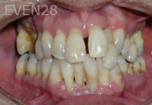 Nicholas-Shubin-Dental-Implants-before-1b