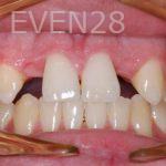Nicholas-Shubin-Dental-Implants-before-3